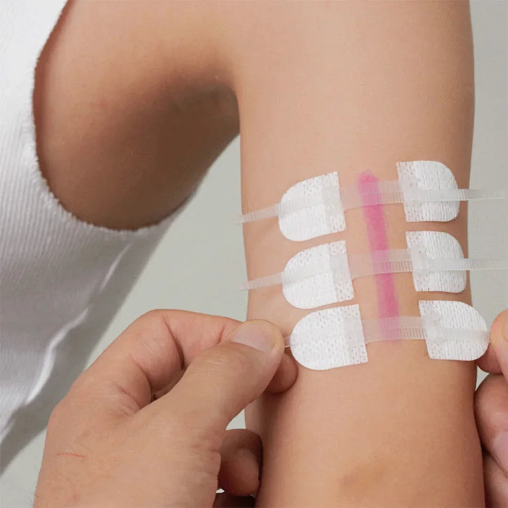 ZIPPER WOUND PATCH