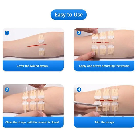 ZIPPER WOUND PATCH